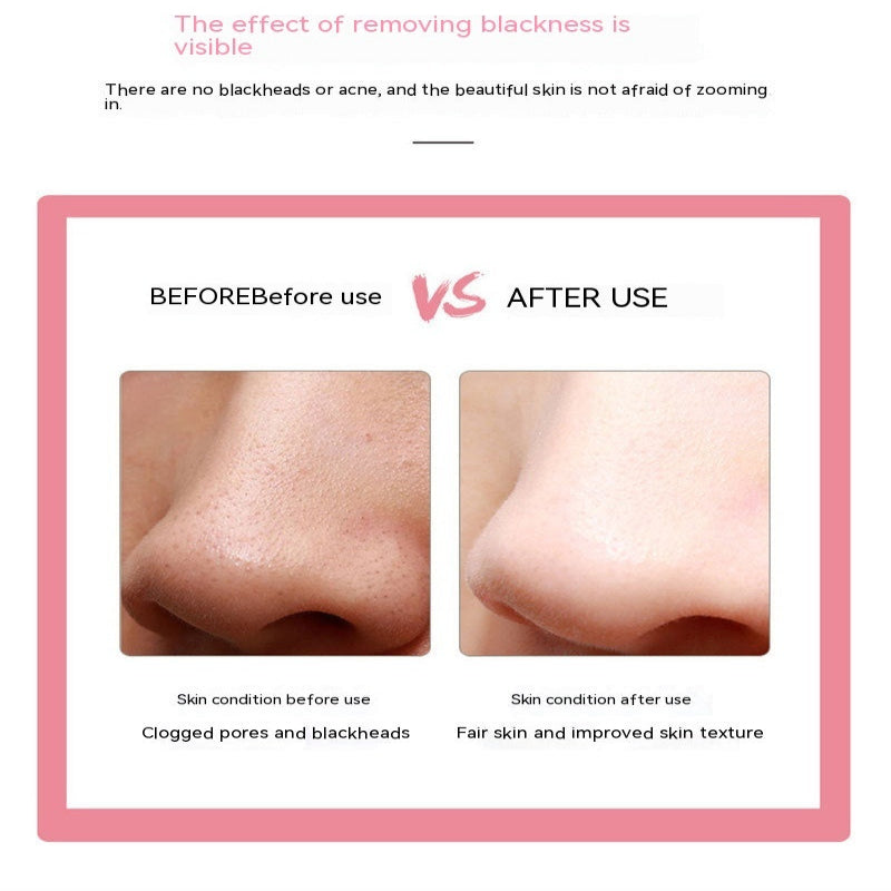 Ergonomic Facial Blackhead Acne Removal Skin Beauty Instrument