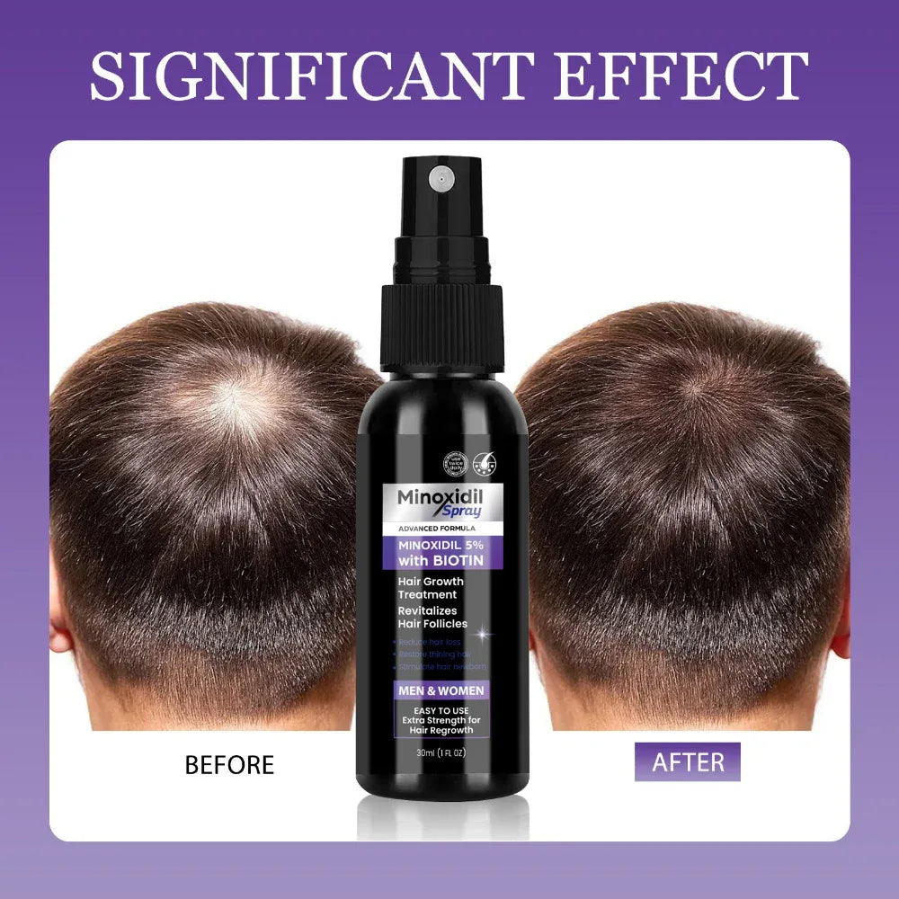Nourishing Anti Hair Loss Minoxidil Hair Care Spray