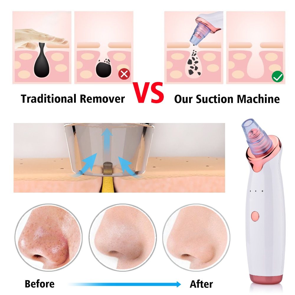 Electric Suction Blackhead Remover Skin Cleaning Device - Weriion