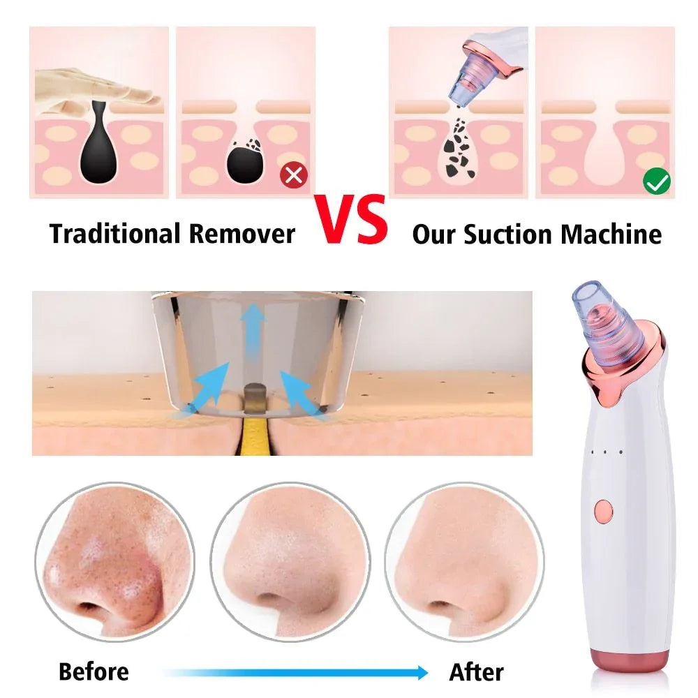 Electric Suction Blackhead Remover Skin Cleaning Device - Weriion